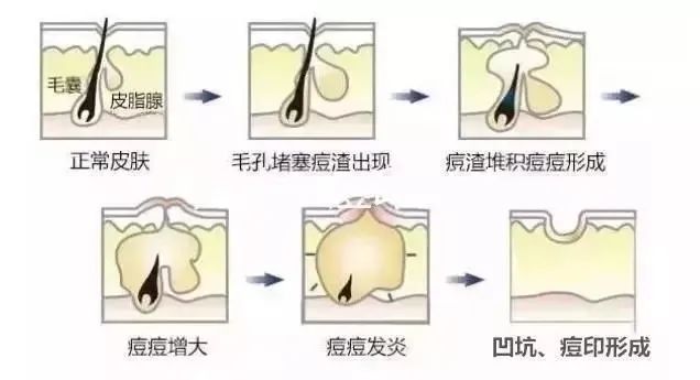 如何祛除痘坑？祛除痘坑最好的方法