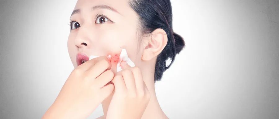 如何預(yù)防粉刺的發(fā)生和痤瘡的形成？