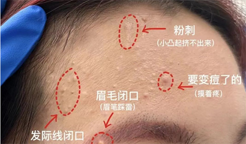 臉上經(jīng)常長閉口粉刺的原因有哪些？