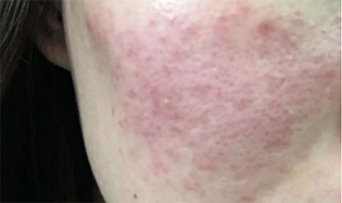 皮膚泛紅癢是什么原因？皮膚紅癢怎么回事？