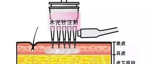 水光針的類(lèi)型有哪幾種？