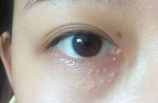 為什么眼部容易長脂肪粒？