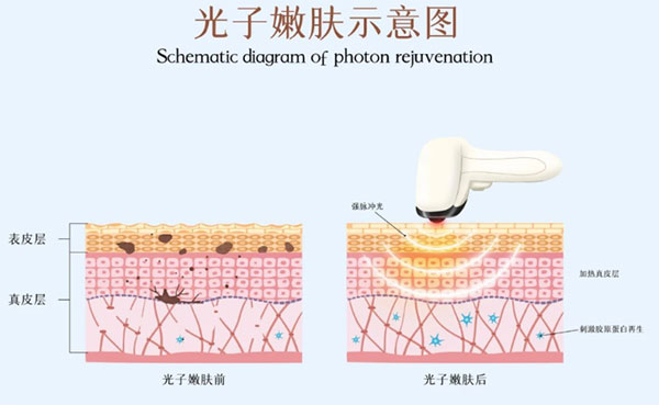 光子嫩膚術(shù)前注意事項有哪些？